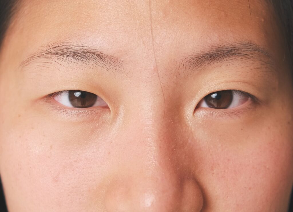 Ptosis Correction Eyelid Surgery Singapore