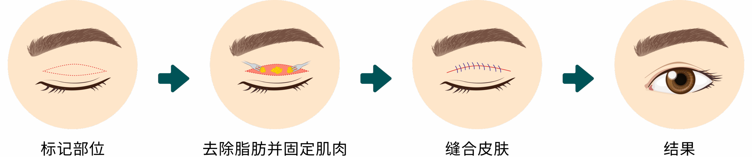 Upper Eyelid Surgery – CN
