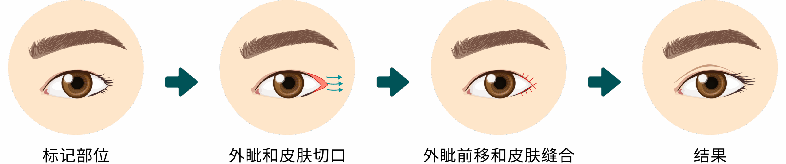 Upper Eyelid Surgery – CN