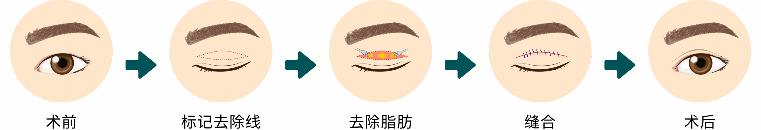 Upper Eyelid Surgery – CN