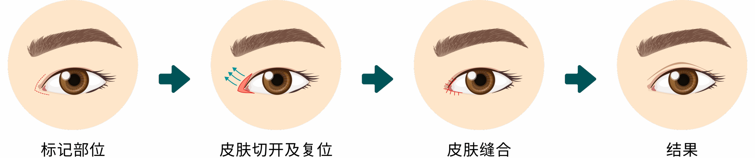 Upper Eyelid Surgery – CN