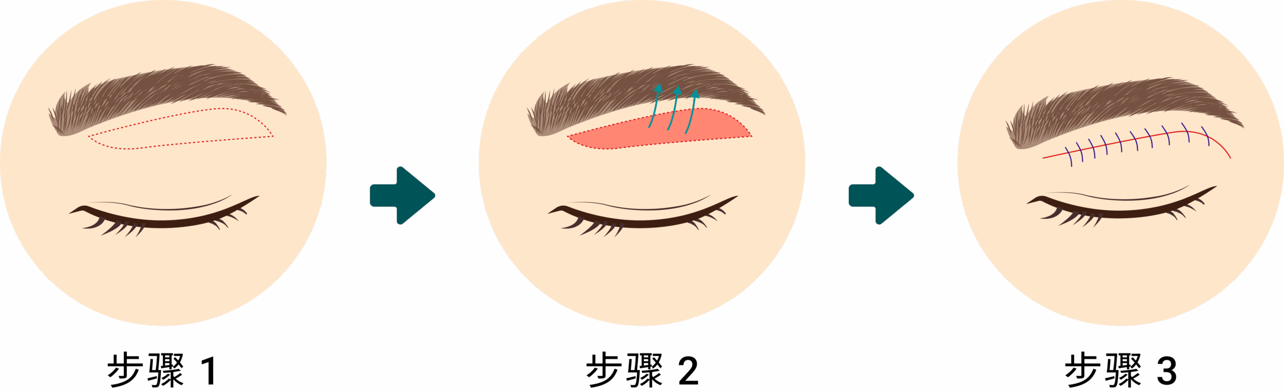 Upper Eyelid Surgery – CN