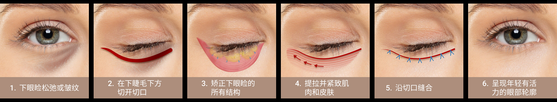 Preservation (Scarless) Eyebag Surgery – CN