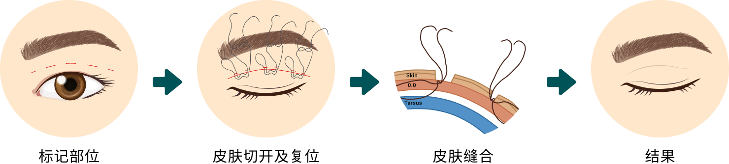 Upper Eyelid Surgery – CN