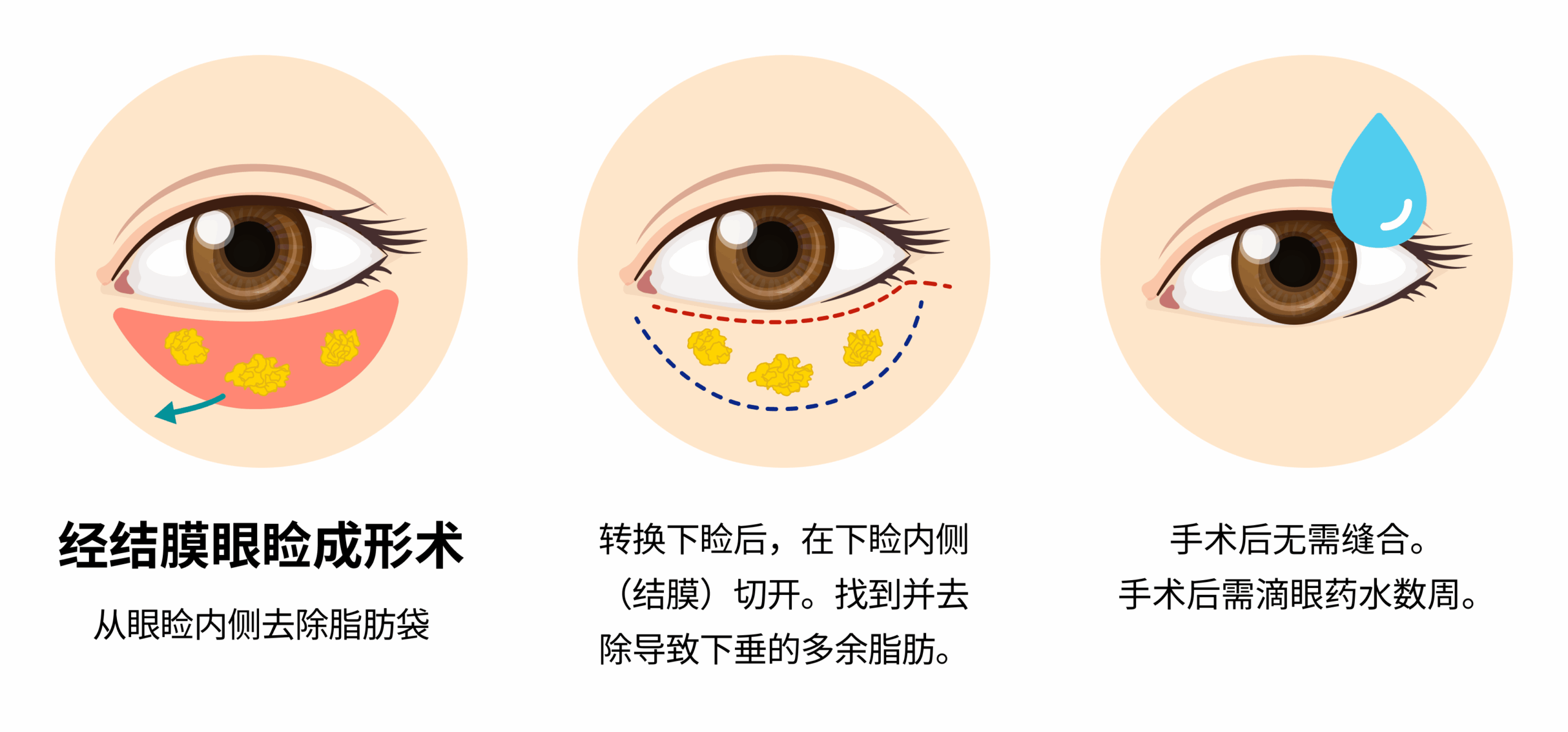 Preservation (Scarless) Eyebag Surgery – CN