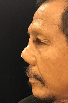 Revision Rhinoplasty Surgery in Singapore