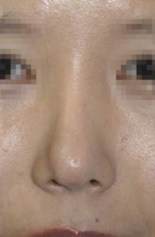 Revision Rhinoplasty Surgery in Singapore