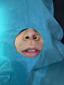 Revision Rhinoplasty Surgery in Singapore