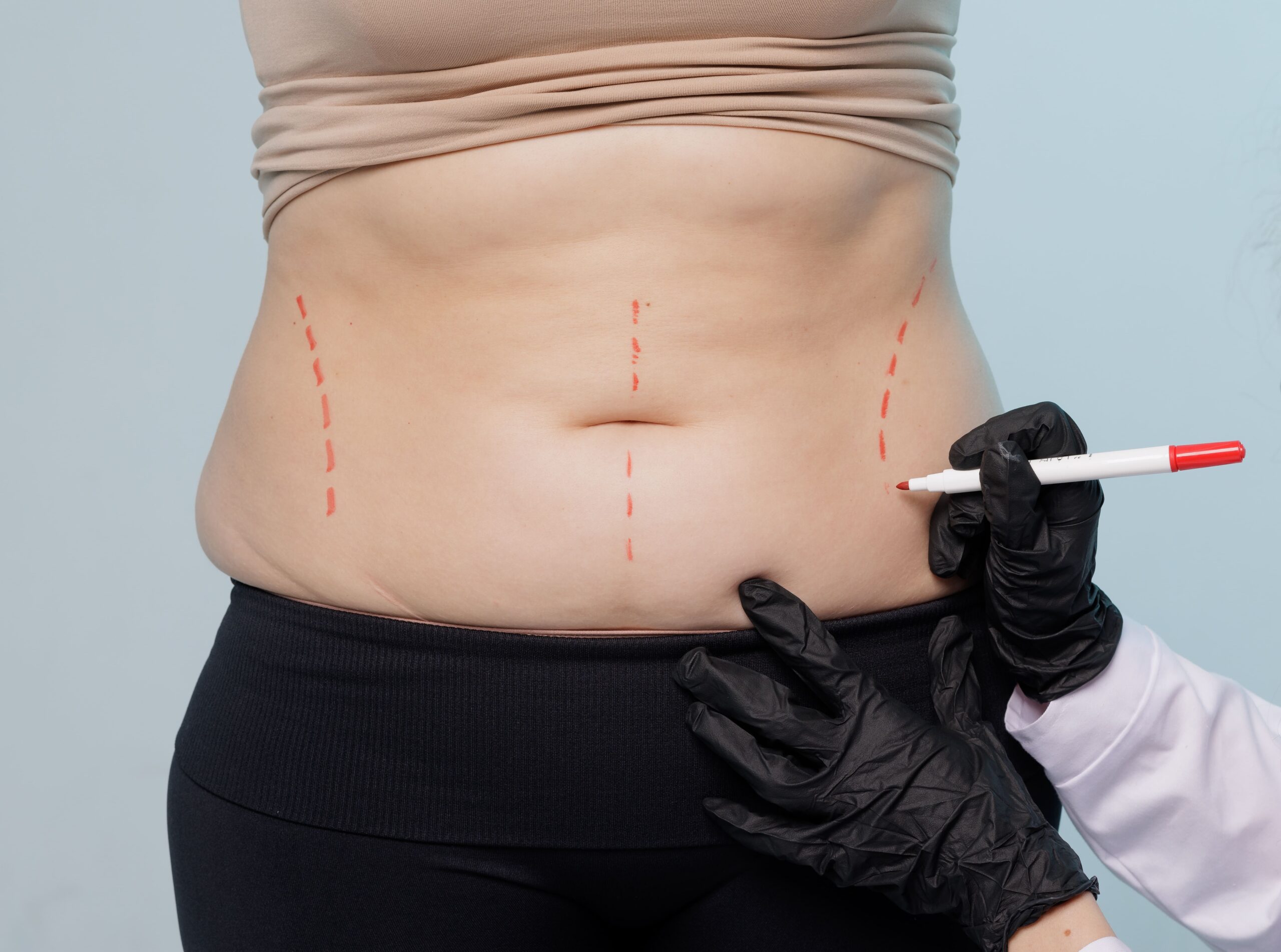 Image close up of doctor drawing marks on woman body bef 2026 01 08 23 22 40 utc