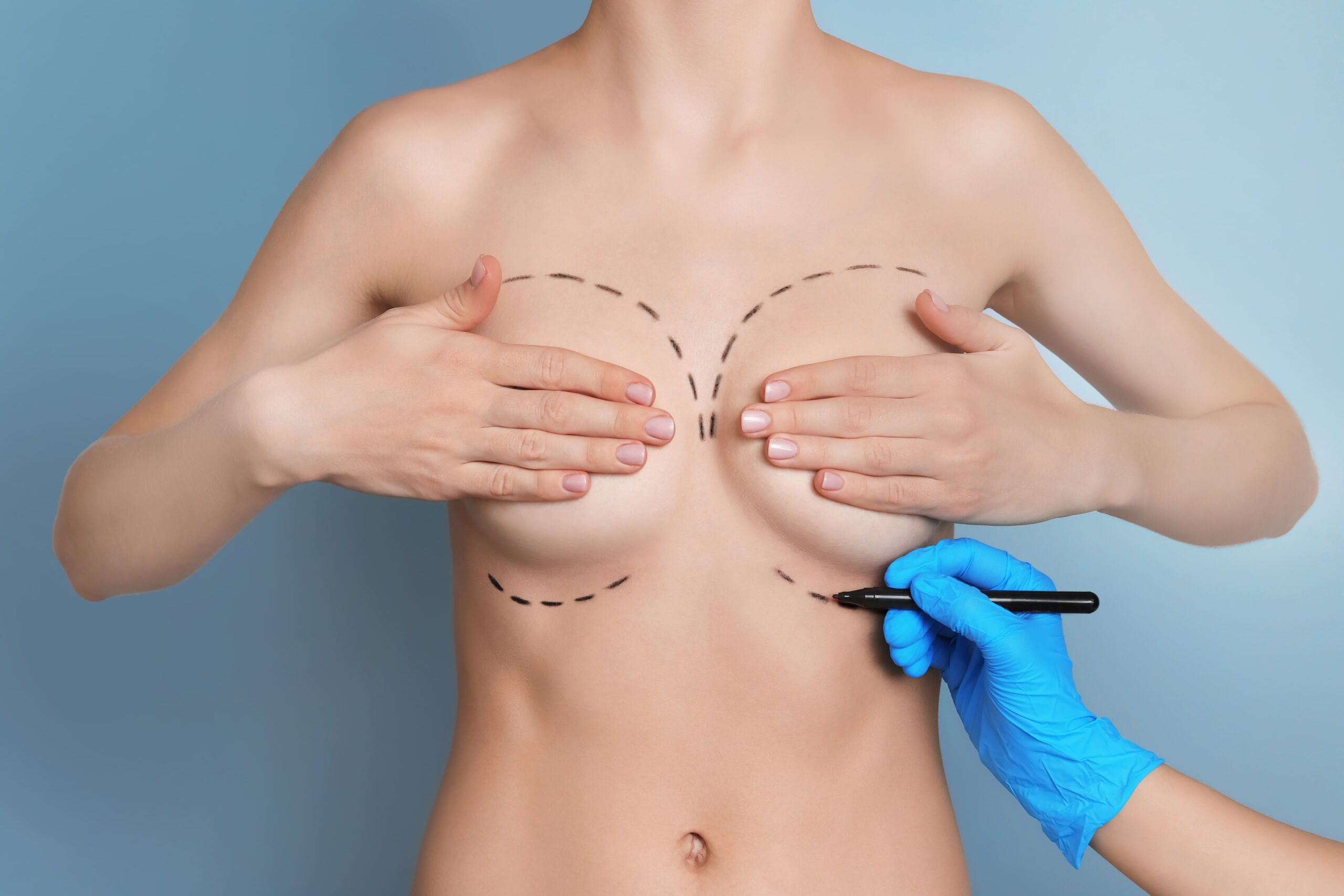 Image doctor drawing marks on female breast for cosmetic 2026 03 27 01 38 25 utc (1)