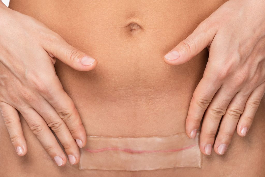 Close-up of an abdomen with a scar and an adhesive bandage.