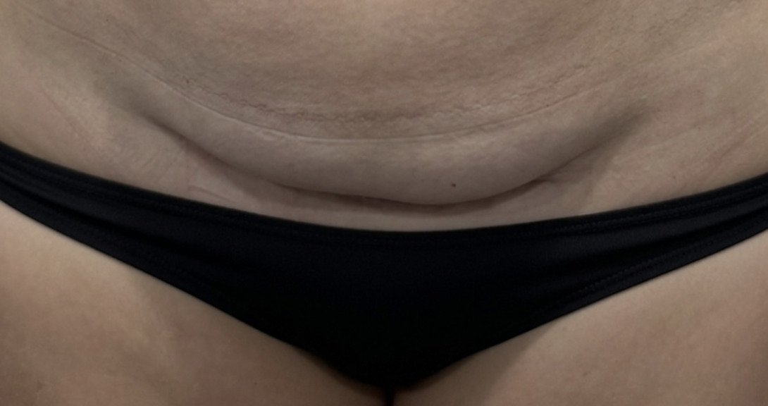 A close-up view of a person's abdominal area showing skin texture and a black bikini.