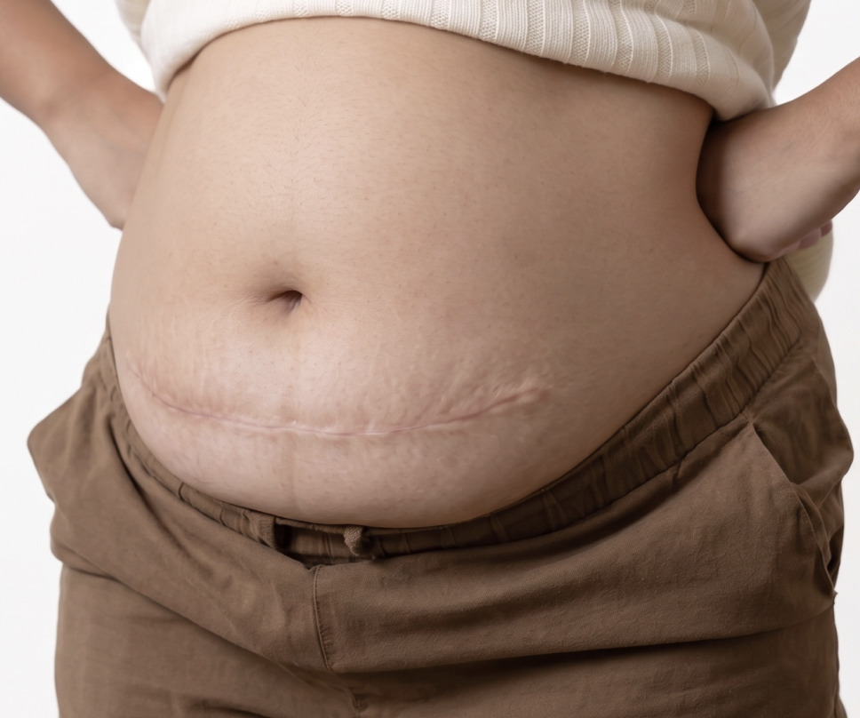 A close-up view of a woman's abdomen showing a surgical scar below the belly button.
