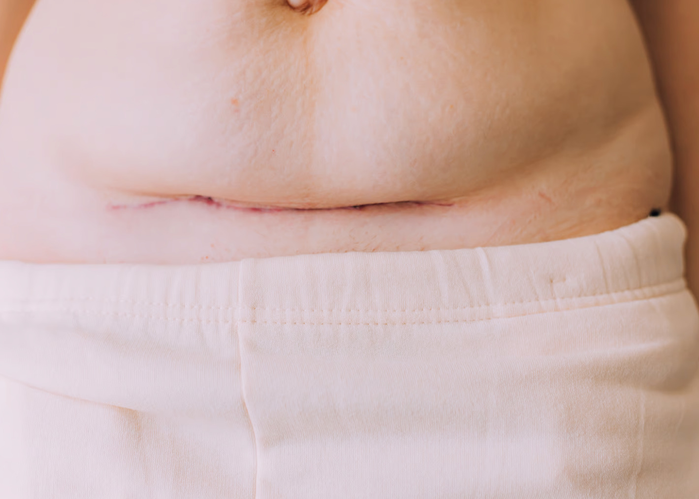 A close-up of a person's abdomen showing a surgical scar and surrounding skin.