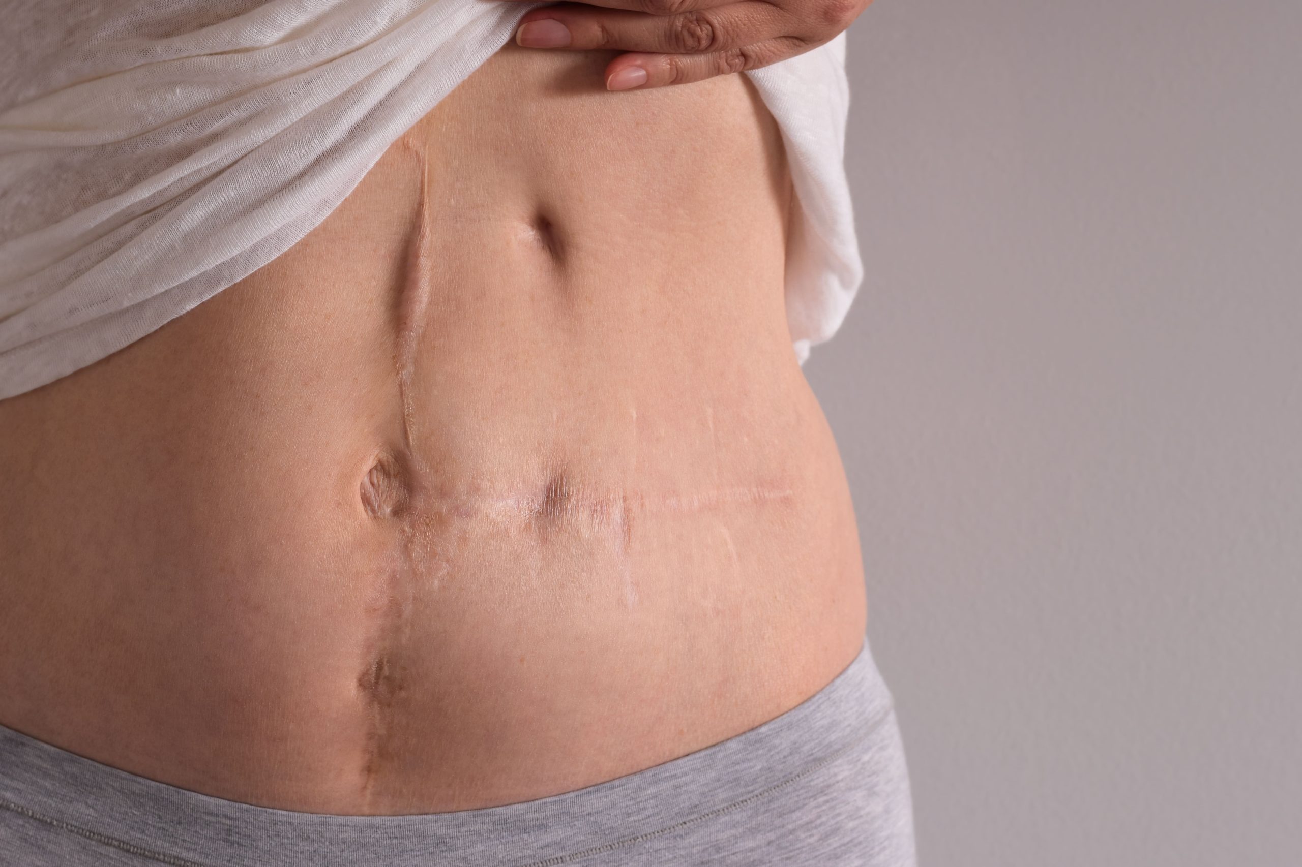 A close-up view of a female abdomen displaying abdominal scars, highlighting body positivity.