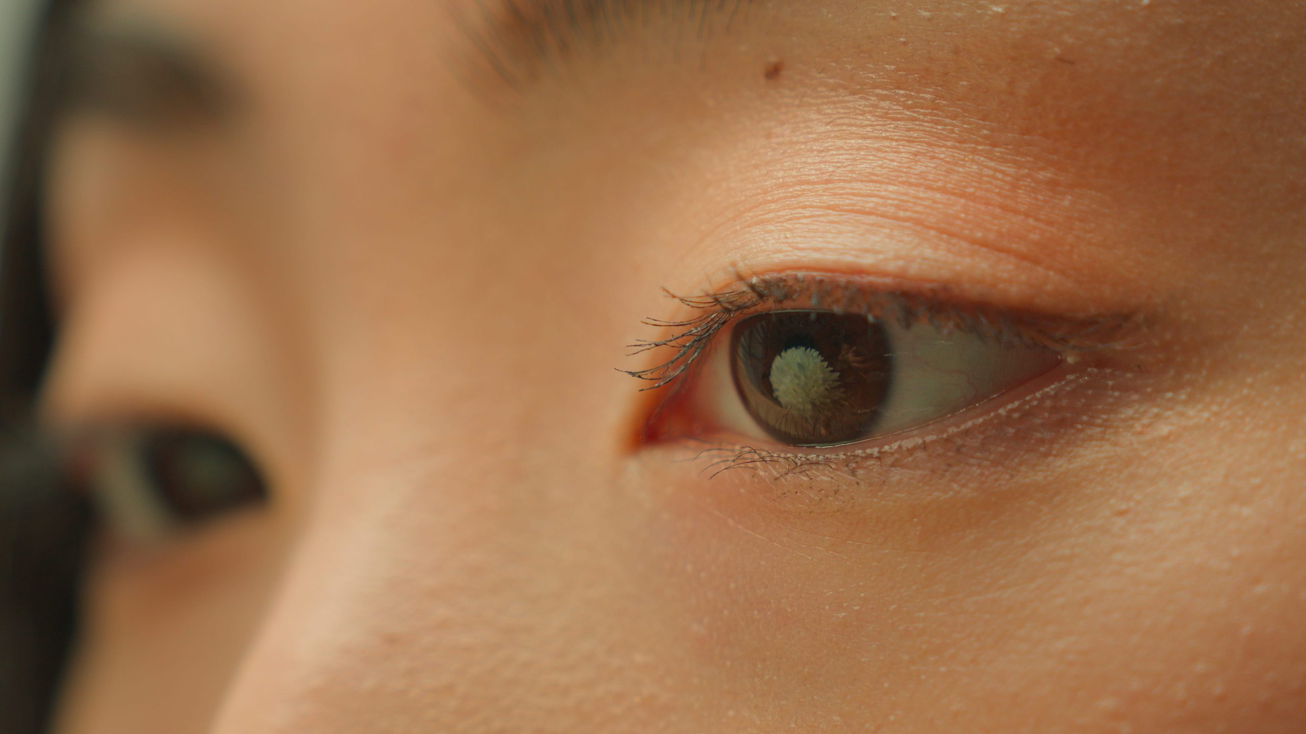 Congenital vs Acquired Ptosis: What Patients Should Know